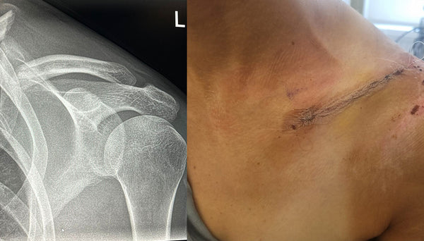 X-ray of a shoulder on the left and a close-up of a surgical incision on the right.